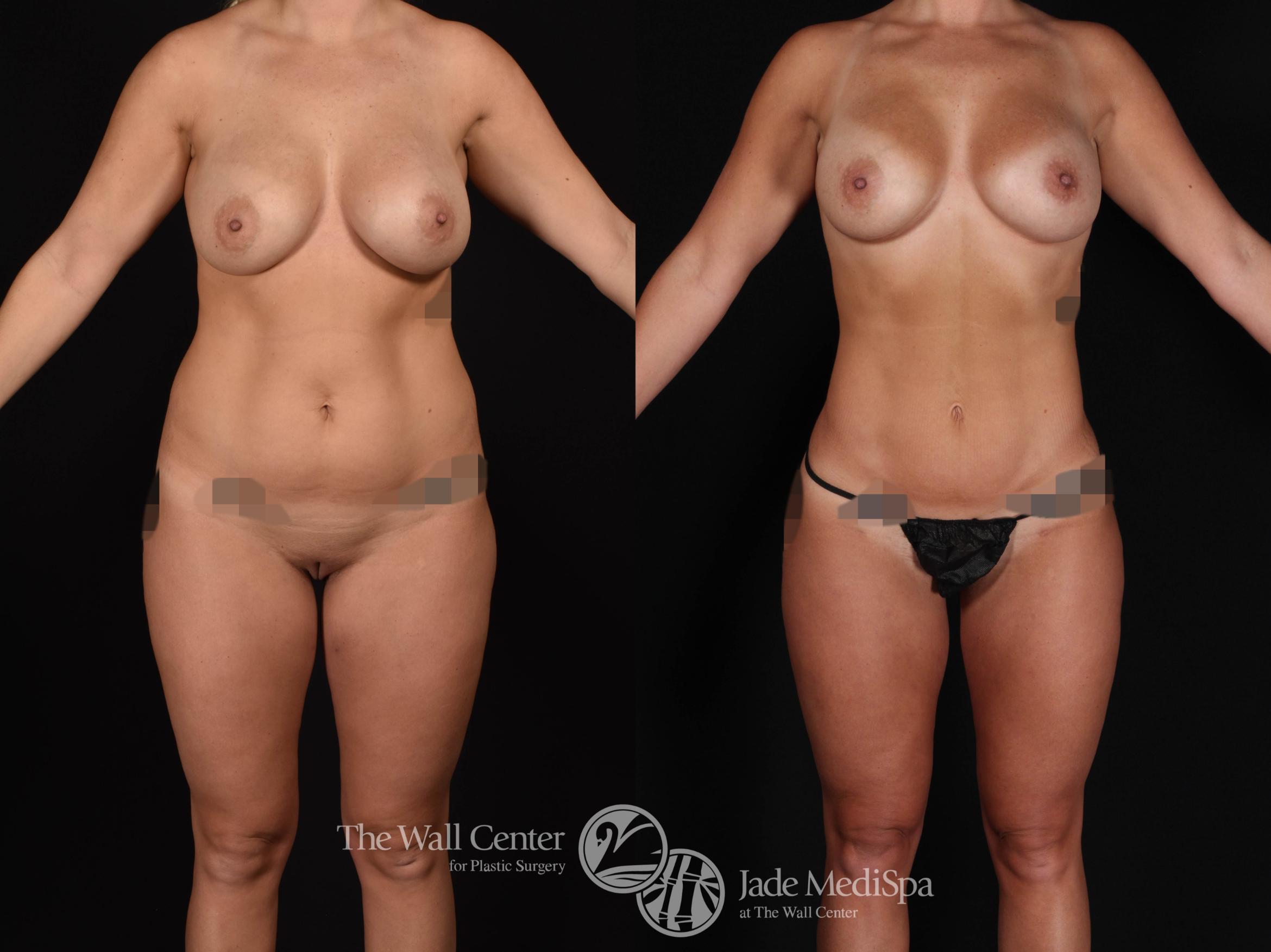 SAFELipo with Fat Grafting to Buttocks Front Photo, Shreveport, Louisiana, The Wall Center for Plastic Surgery, Case 940