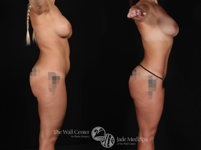 SAFELipo with Fat Grafting to Buttocks Right Side Photo, Shreveport, Louisiana, The Wall Center for Plastic Surgery, Case 940