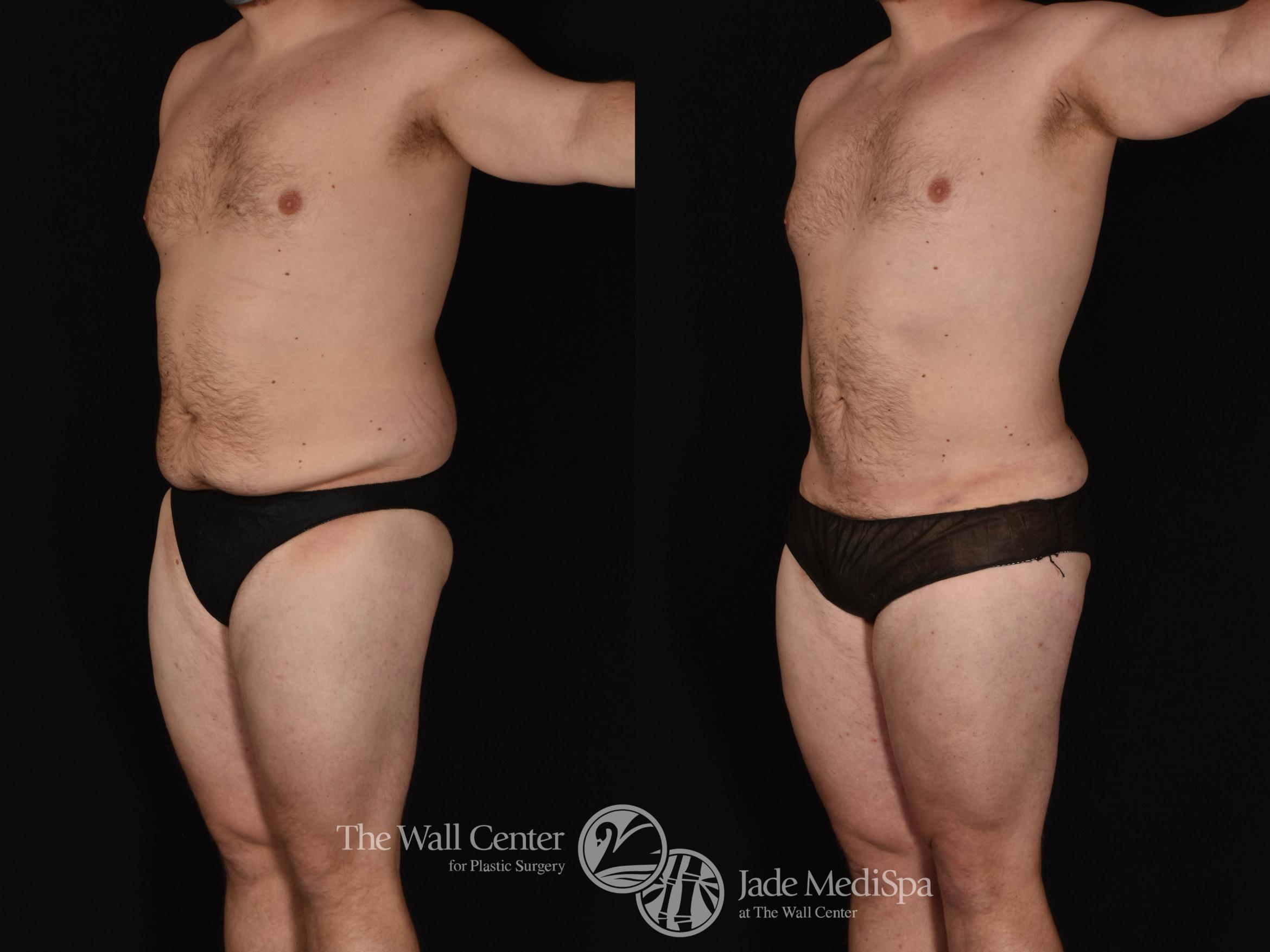 SAFELipo Abdomen Left Oblique Photo, Shreveport, Louisiana, The Wall Center for Plastic Surgery, Case 968