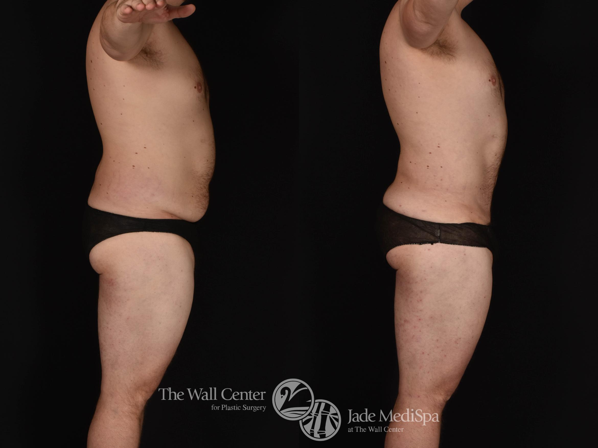 SAFELipo Abdomen Right Side Photo, Shreveport, Louisiana, The Wall Center for Plastic Surgery, Case 968