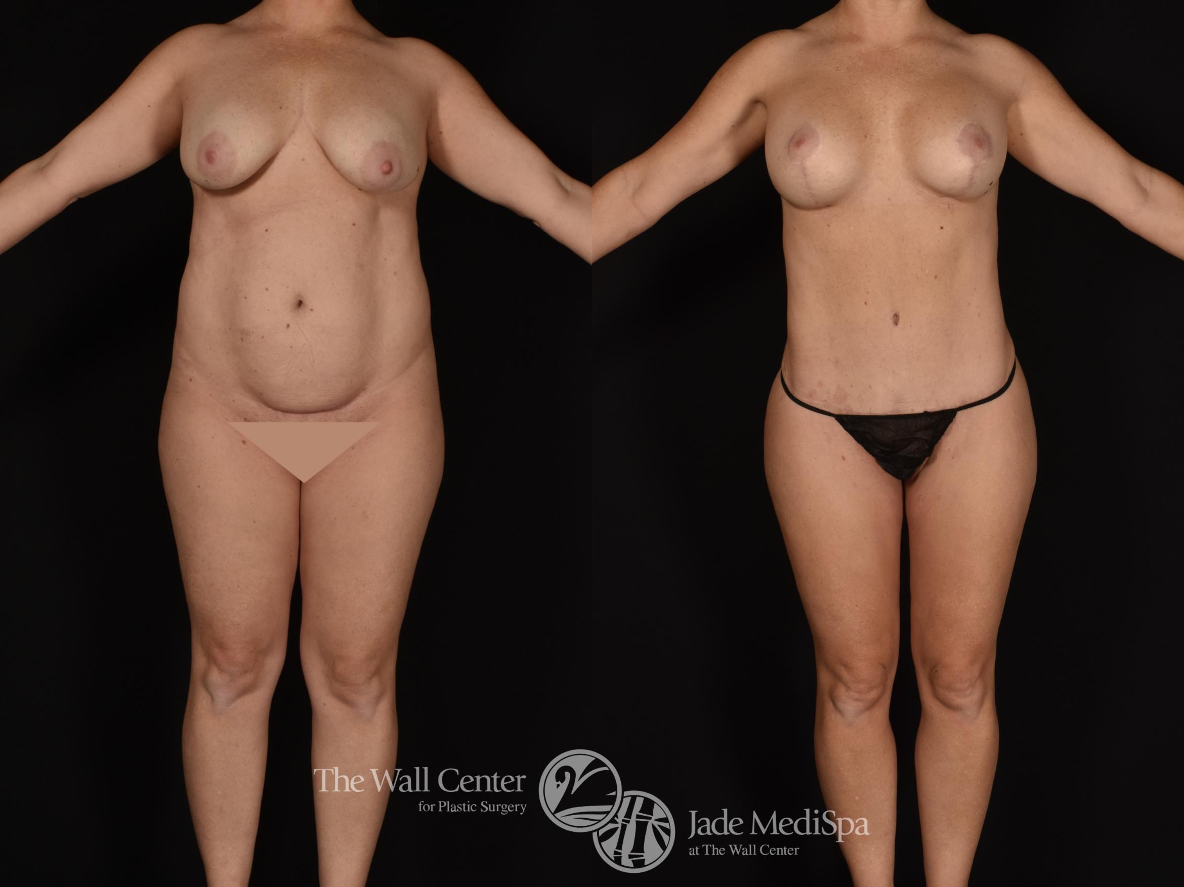 Before & After Tummy Tuck Case 1017 Front View in Shreveport, LA