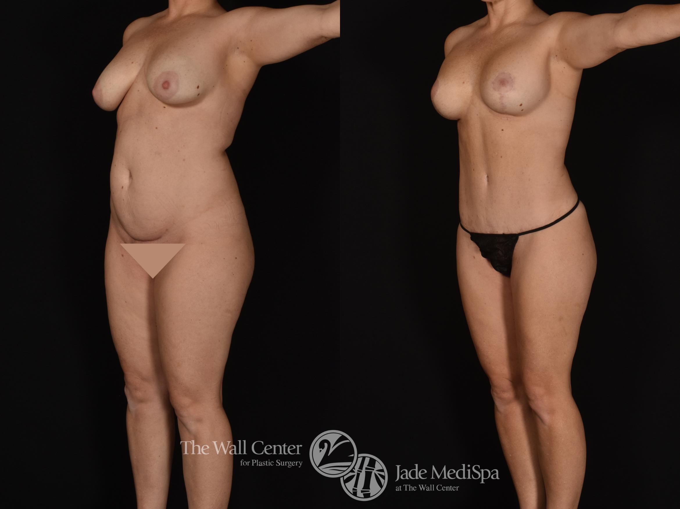 Before & After Tummy Tuck Case 1017 Left Oblique View in Shreveport, LA