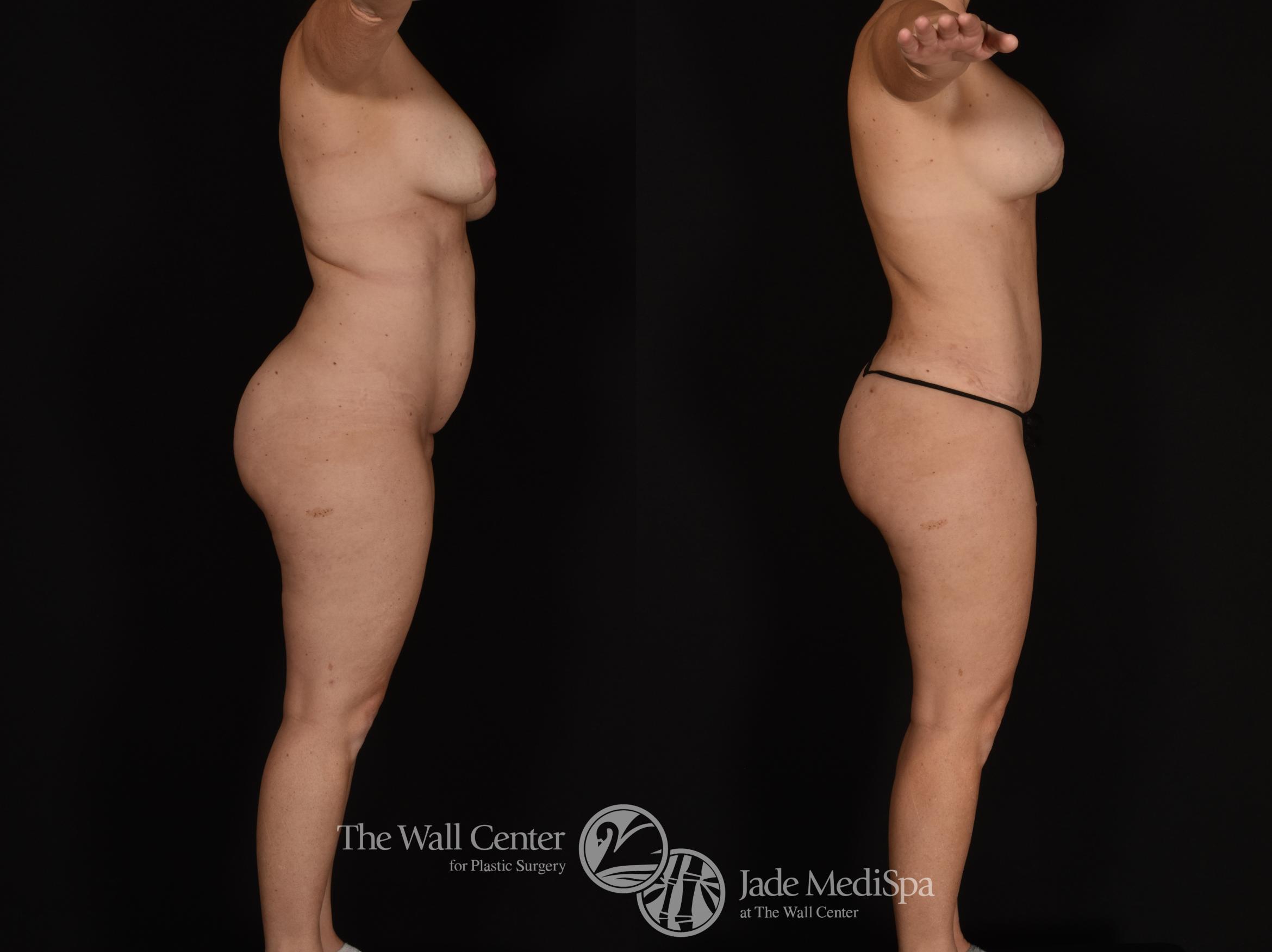 Before & After Tummy Tuck Case 1017 Right Side View in Shreveport, LA