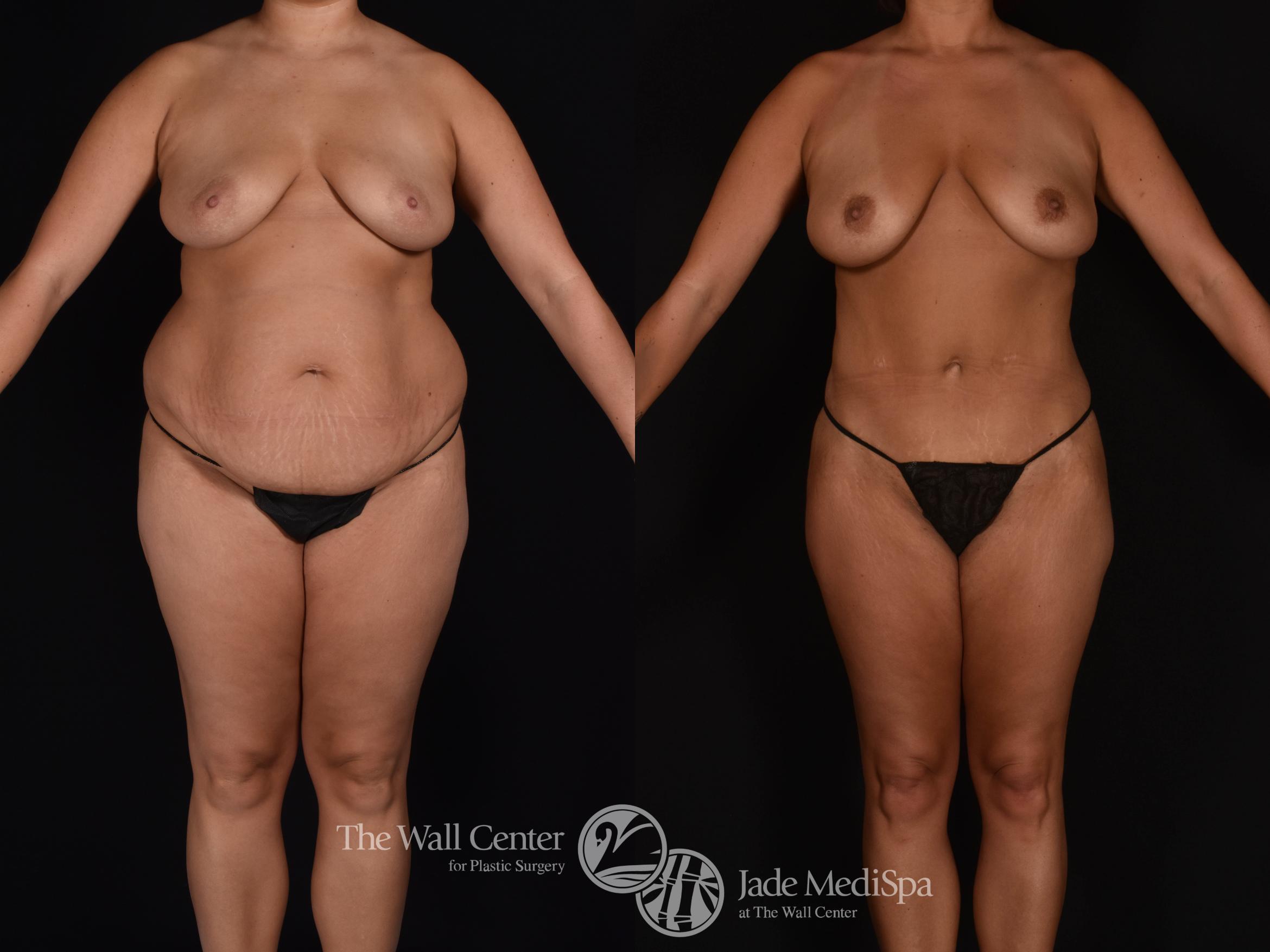 Before & After Tummy Tuck Case 1022 Front View in Shreveport, LA