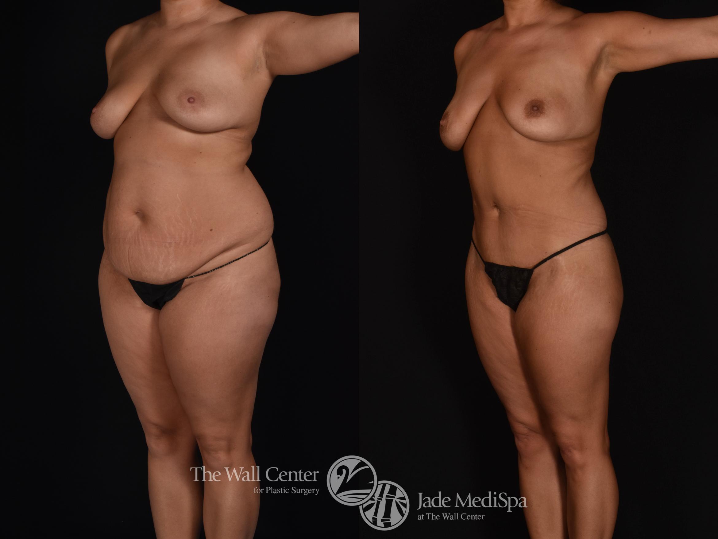 Before & After Tummy Tuck Case 1022 Left Oblique View in Shreveport, LA