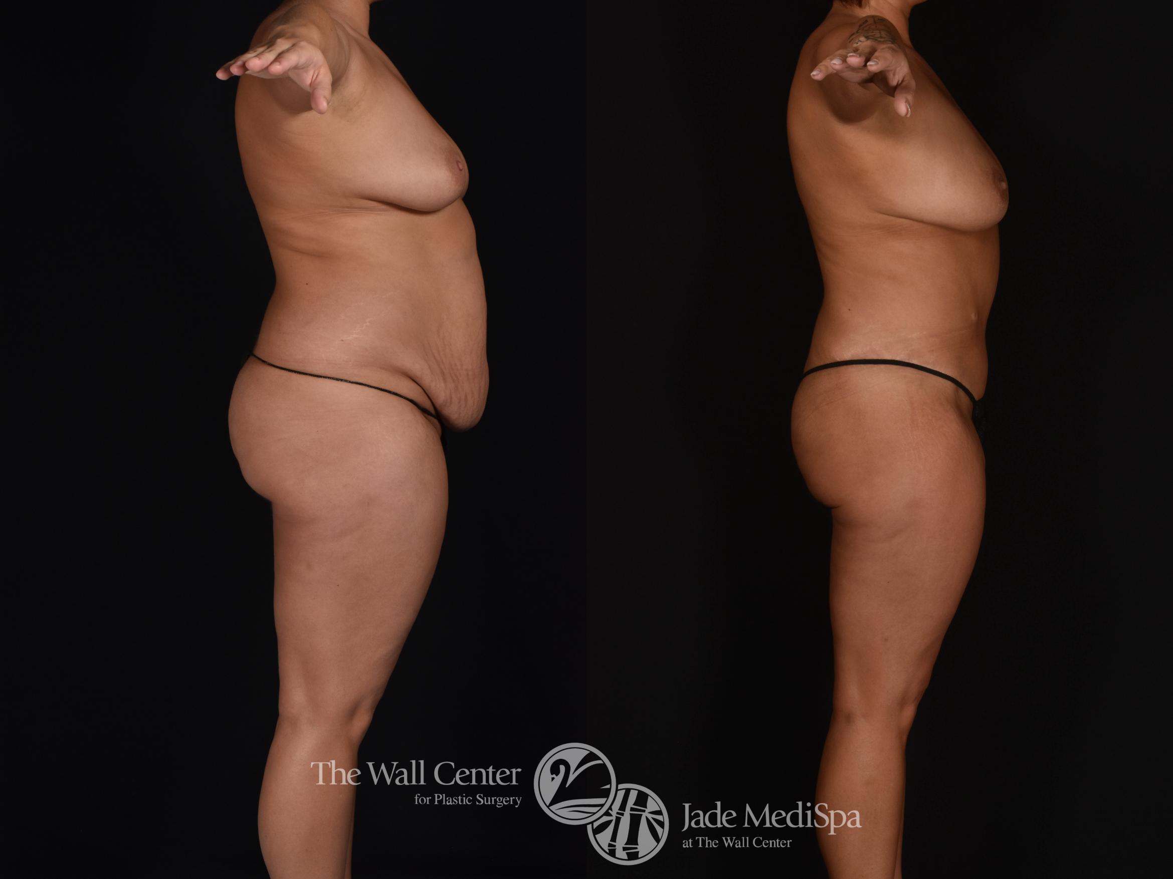 Before & After Tummy Tuck Case 1022 Right Side View in Shreveport, LA