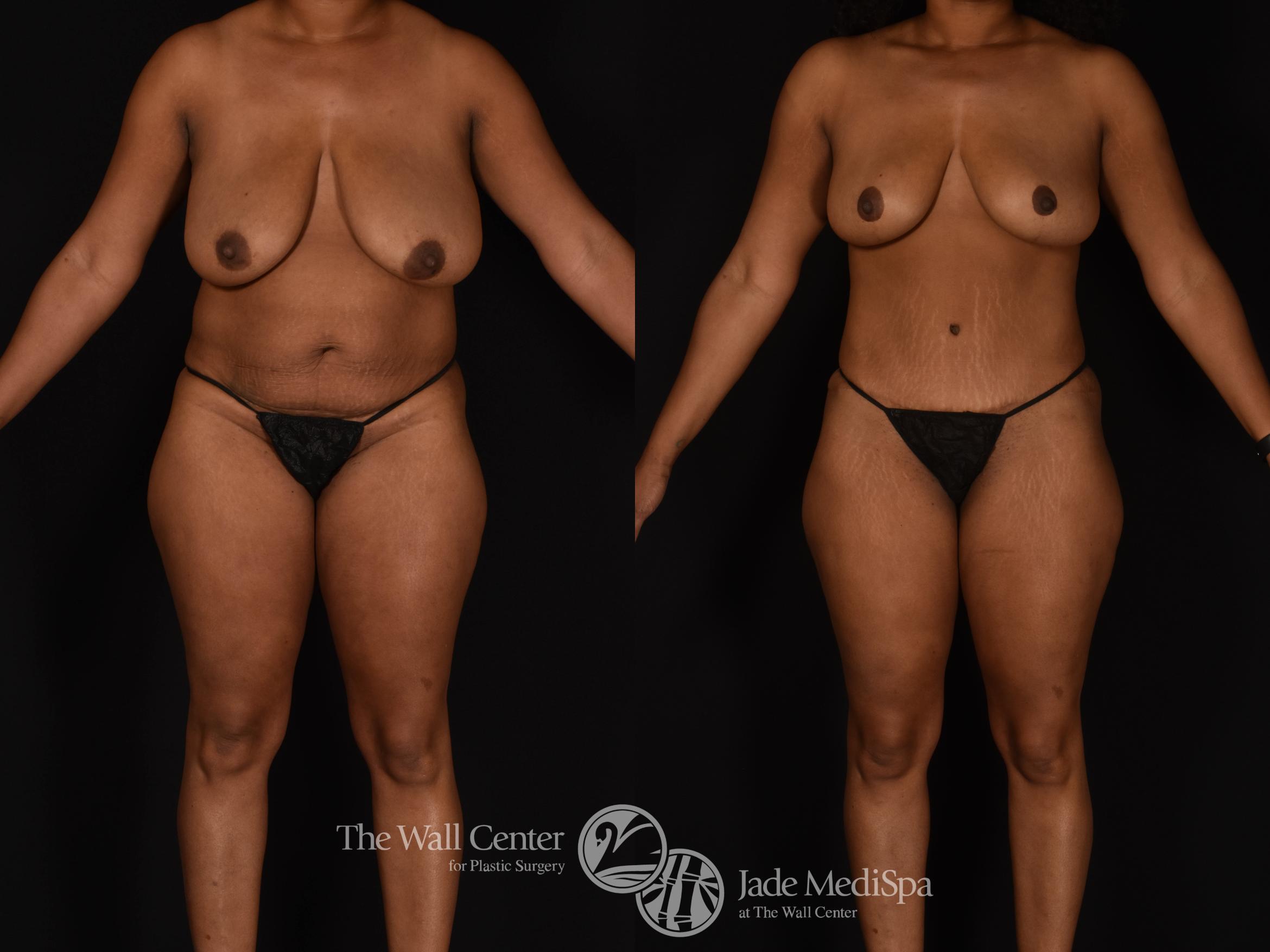 Before & After Tummy Tuck Case 1024 Front View in Shreveport, LA