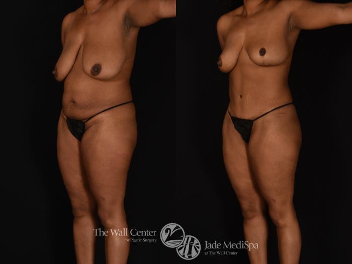 Before & After Tummy Tuck Case 1024 Left Oblique View in Shreveport, LA