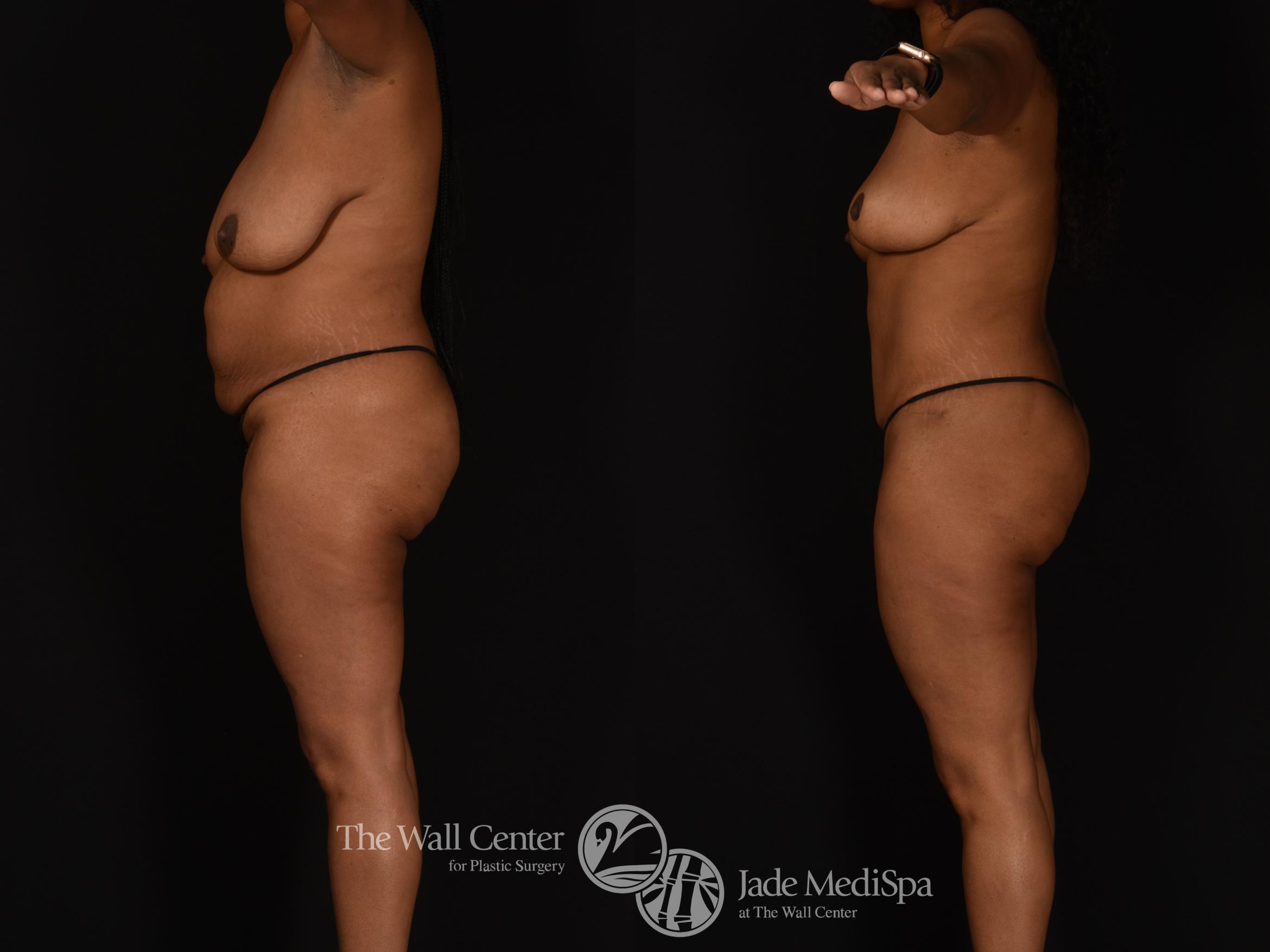 Before & After Tummy Tuck Case 1024 Left Side View in Shreveport, LA