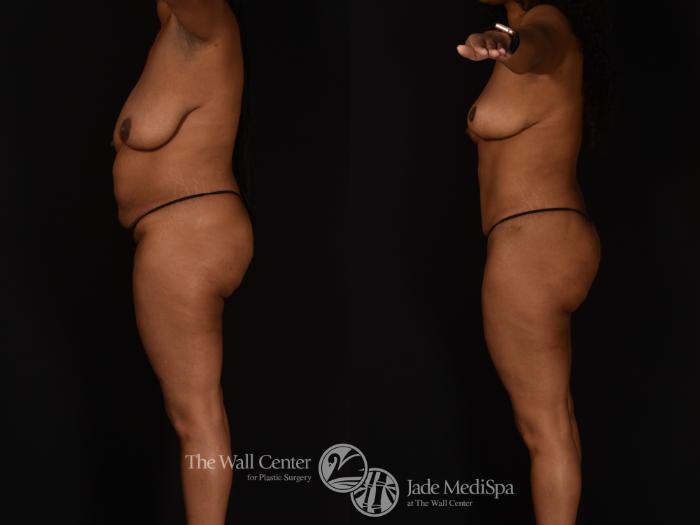 Before & After Tummy Tuck Case 1024 Left Side View in Shreveport, LA