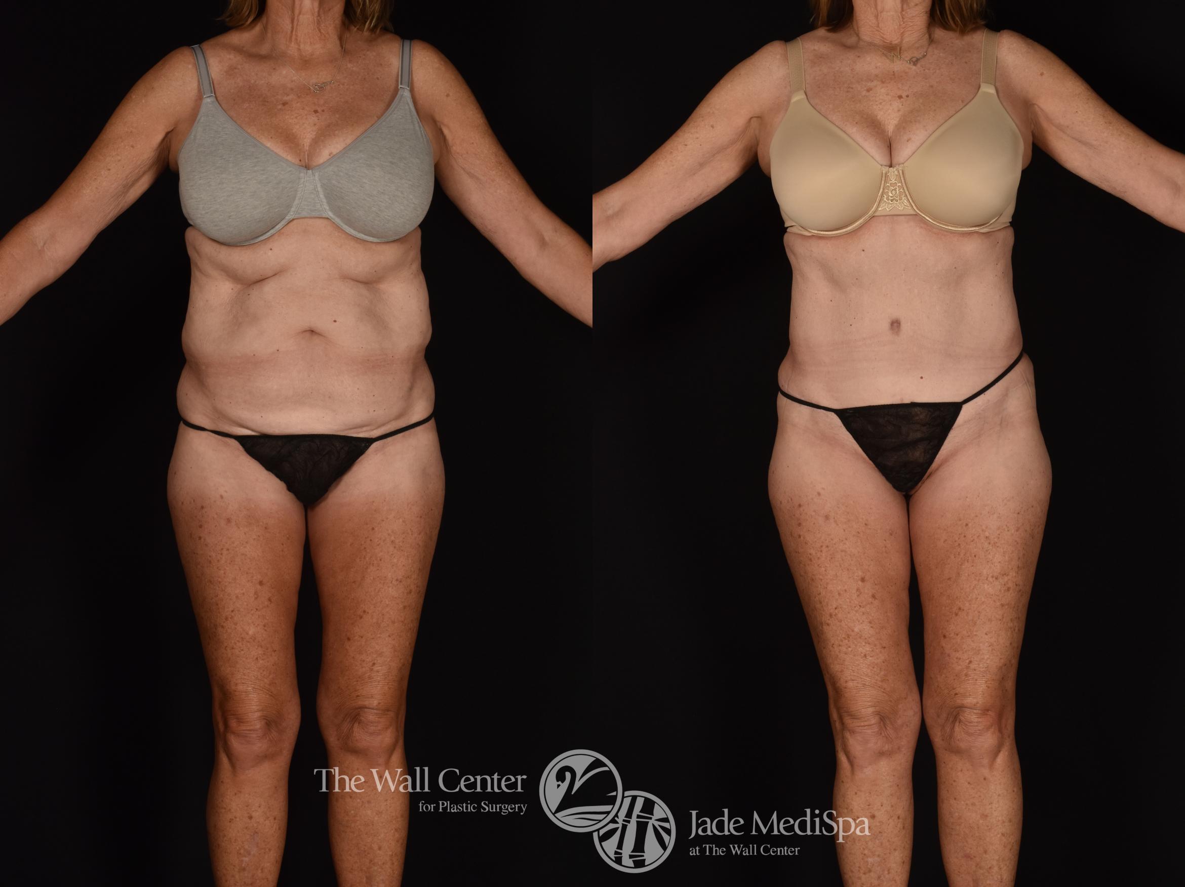 Before & After Tummy Tuck Case 1028 Front View in Shreveport, LA