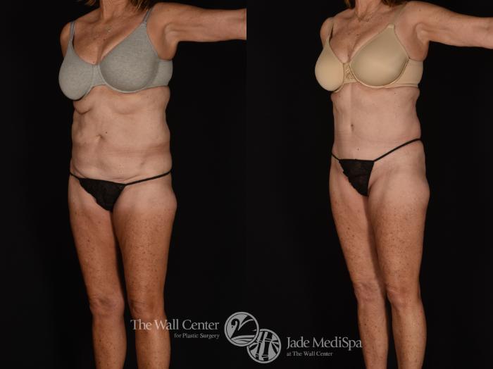 Before & After Tummy Tuck Case 1028 Left Oblique View in Shreveport, LA