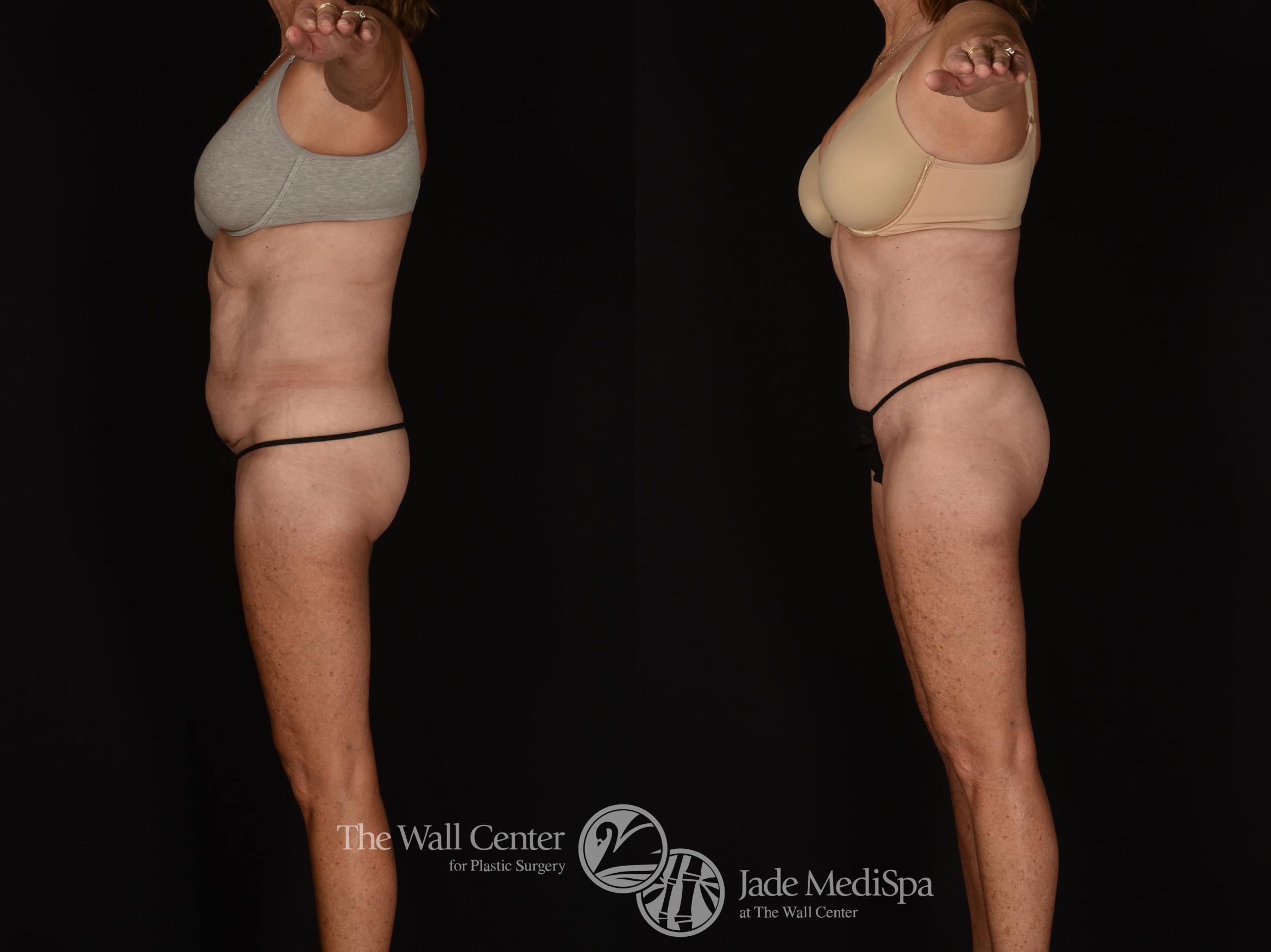 Before & After Tummy Tuck Case 1028 Left Side View in Shreveport, LA