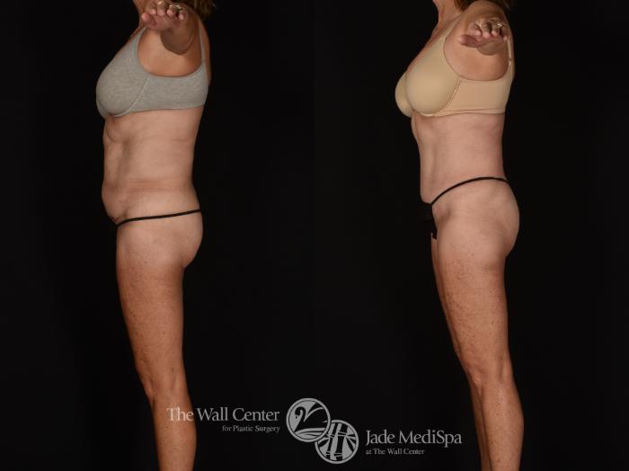 Before & After Tummy Tuck Case 1028 Left Side View in Shreveport, LA