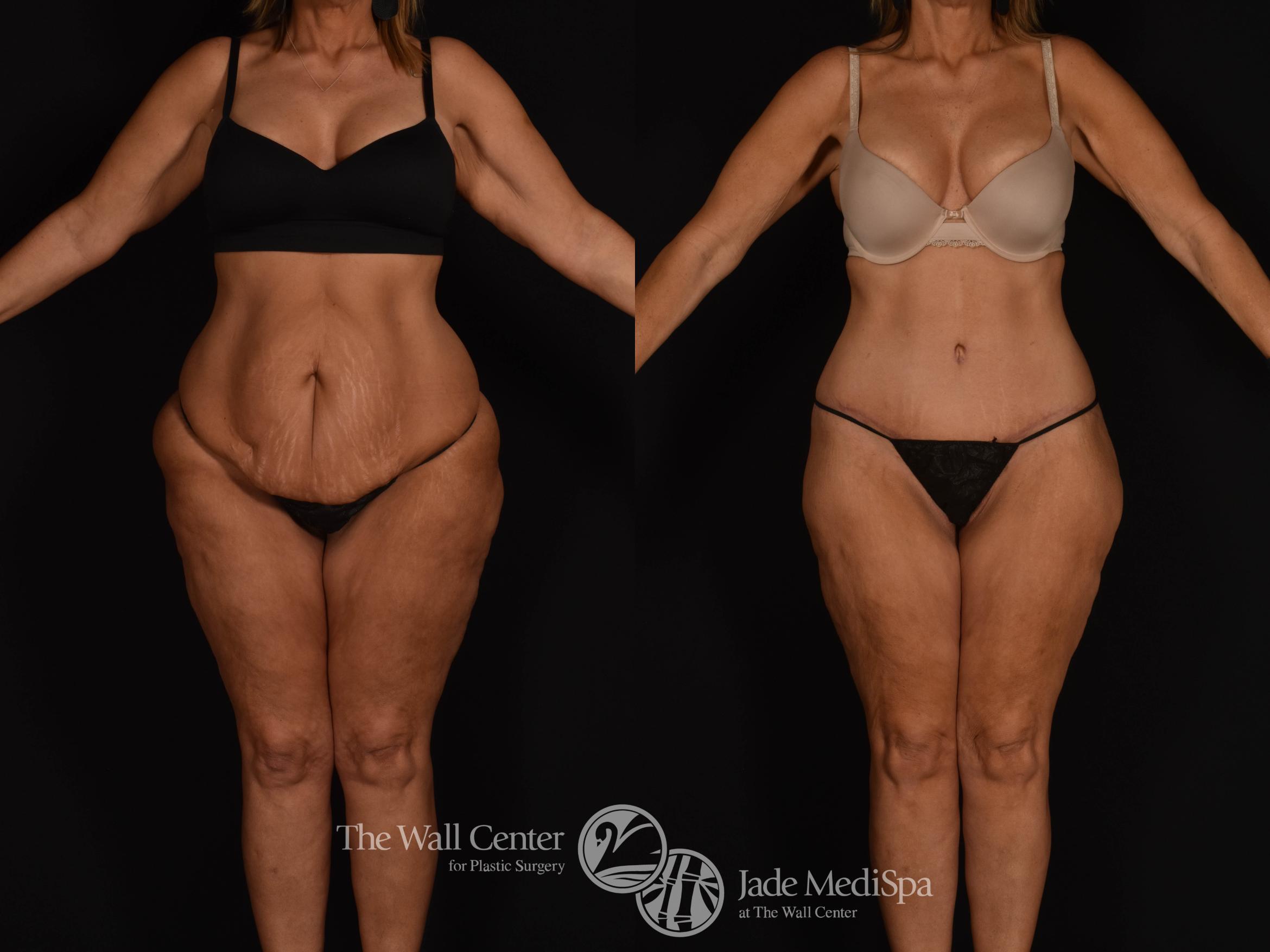 Tummy Tuck