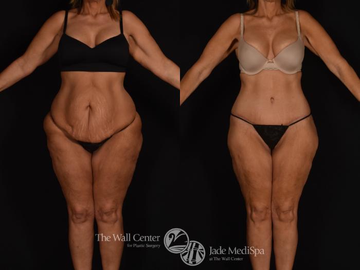 Before & After Tummy Tuck Case 1039 Front View in Shreveport, LA