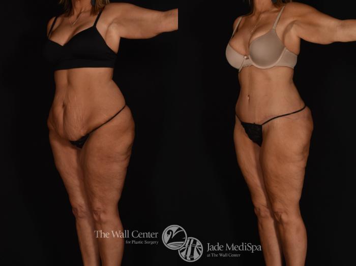 Before & After Tummy Tuck Case 1039 Left Oblique View in Shreveport, LA