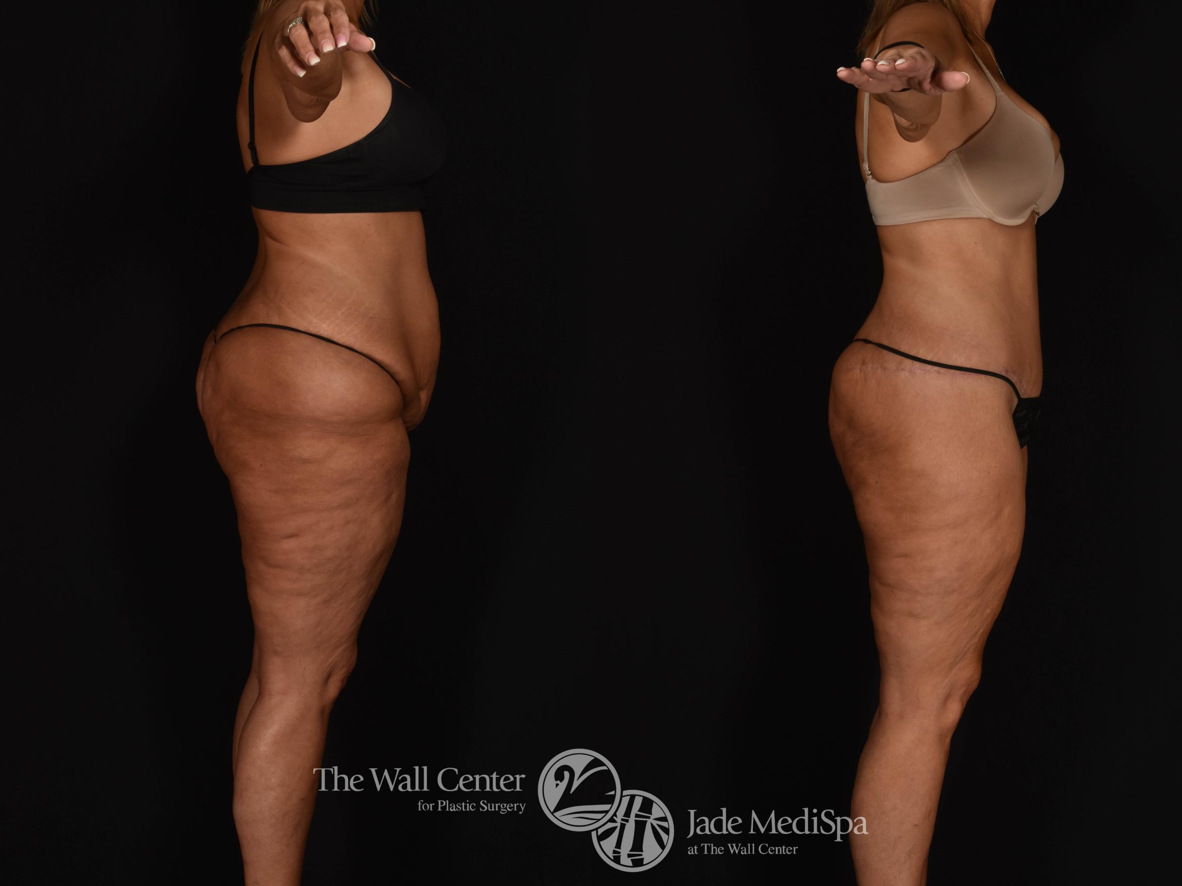 Before & After Tummy Tuck Case 1039 Right Side View in Shreveport, LA