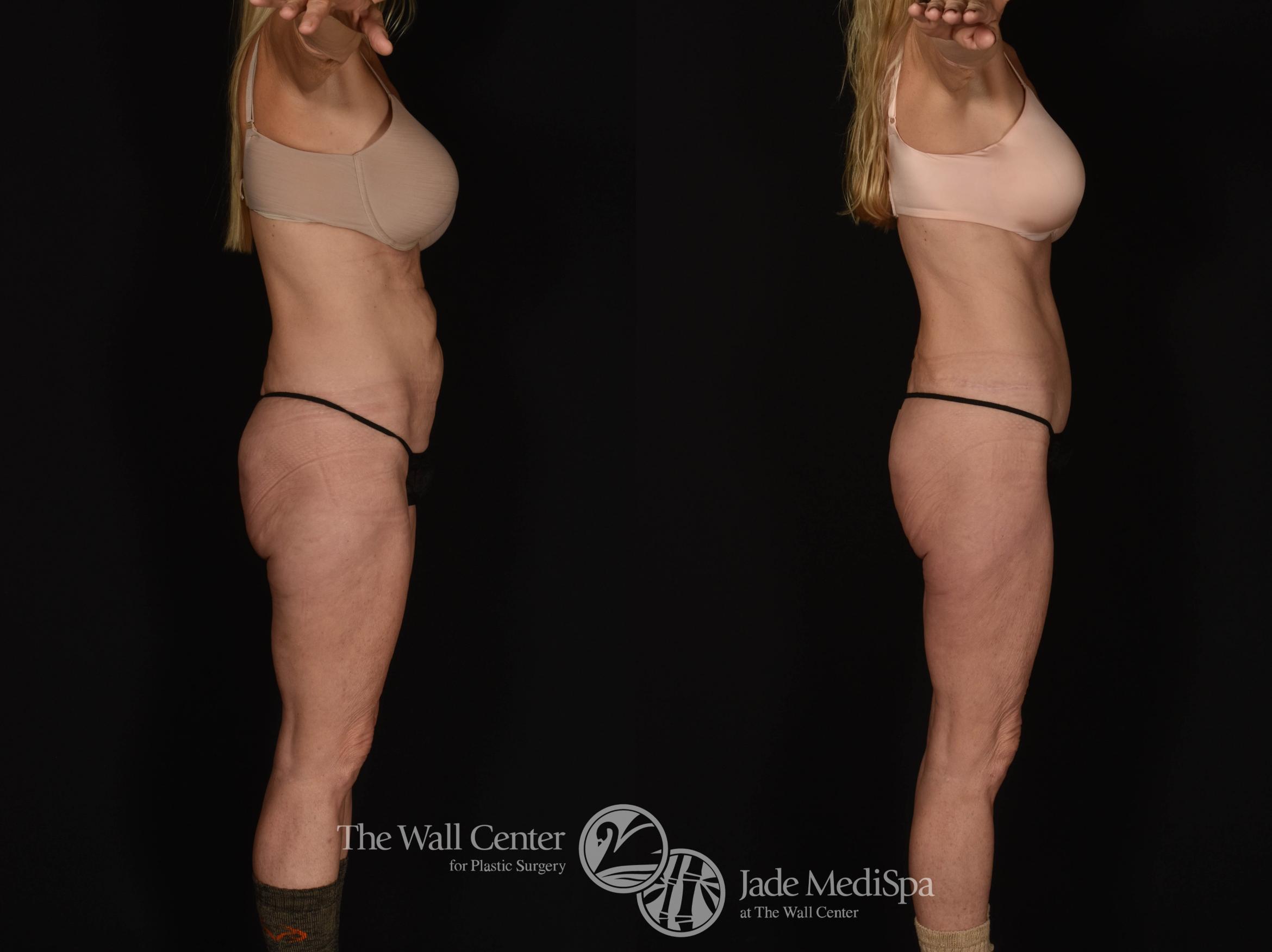 Before & After Tummy Tuck Case 1042 Right Side View in Shreveport, LA