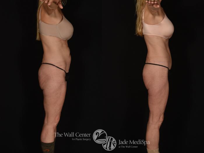 Before & After Tummy Tuck Case 1042 Right Side View in Shreveport, LA