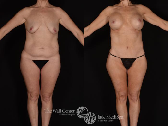Before & After Tummy Tuck Case 1062 Front View in Shreveport, LA