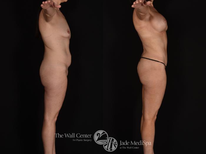 Before & After Tummy Tuck Case 1062 Right Side View in Shreveport, LA