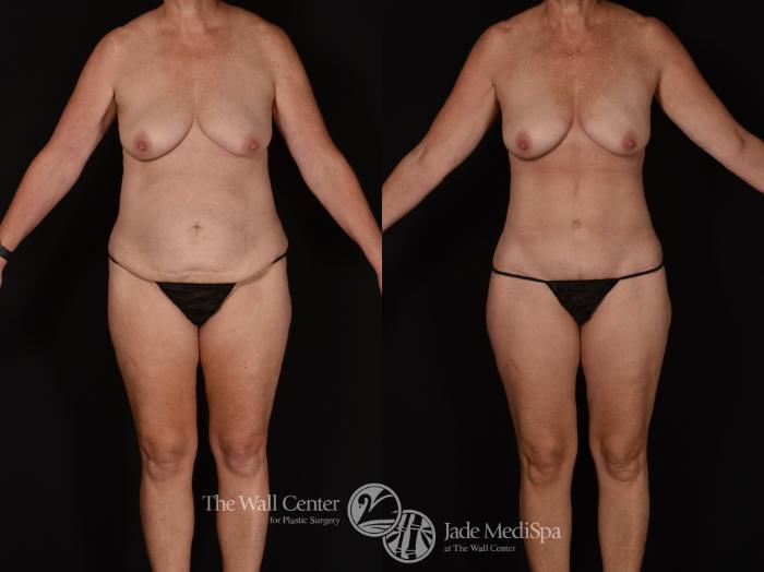 Before & After Tummy Tuck Case 1074 Front View in Shreveport, LA
