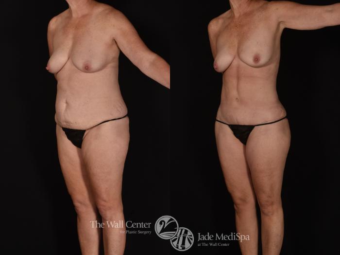 Before & After Tummy Tuck Case 1074 Left Oblique View in Shreveport, LA