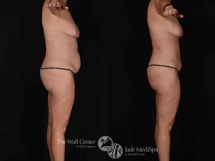 Before & After Tummy Tuck Case 1074 Right Side View in Shreveport, LA