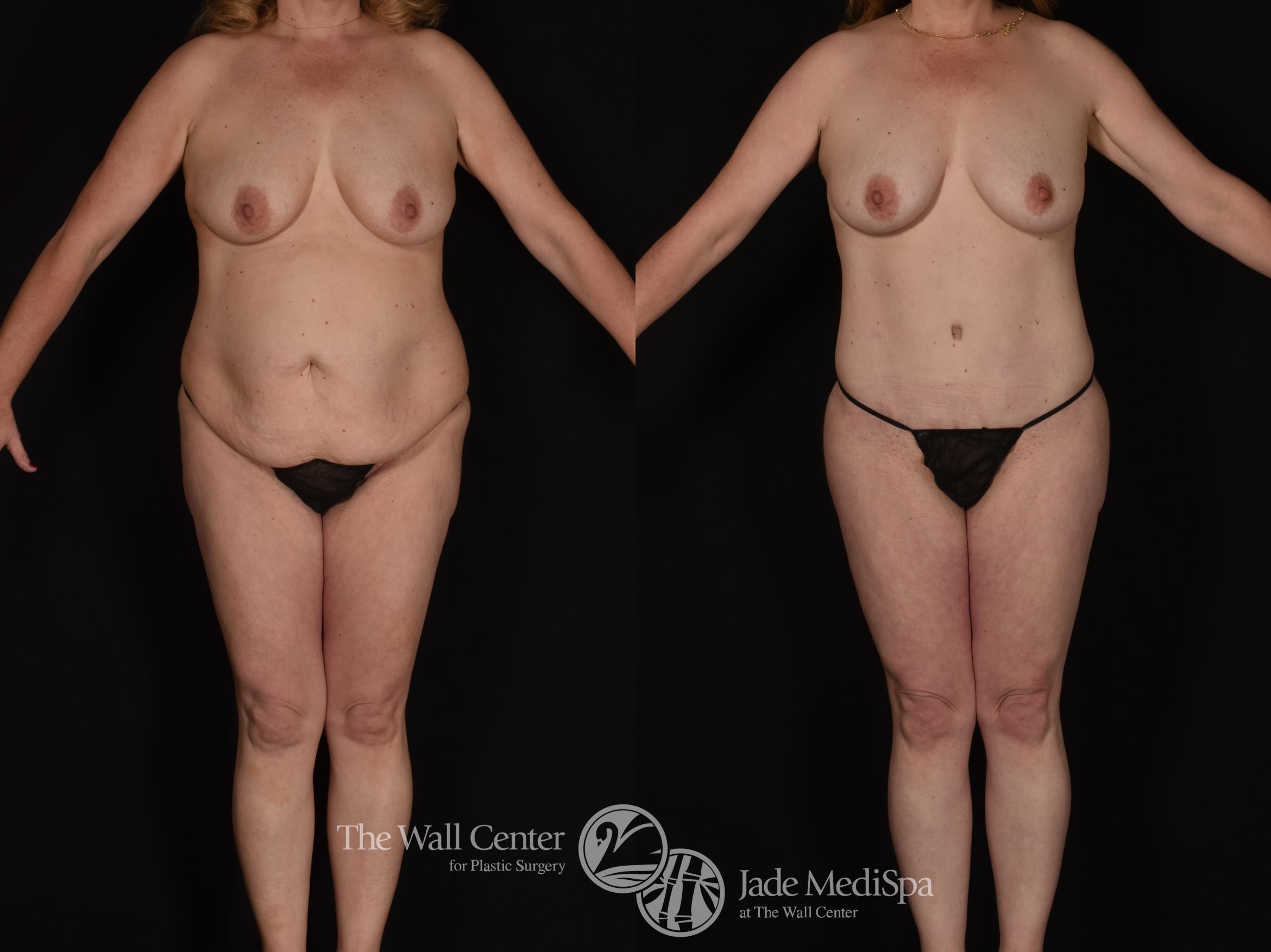 Before & After Tummy Tuck Case 1076 Front View in Shreveport, LA
