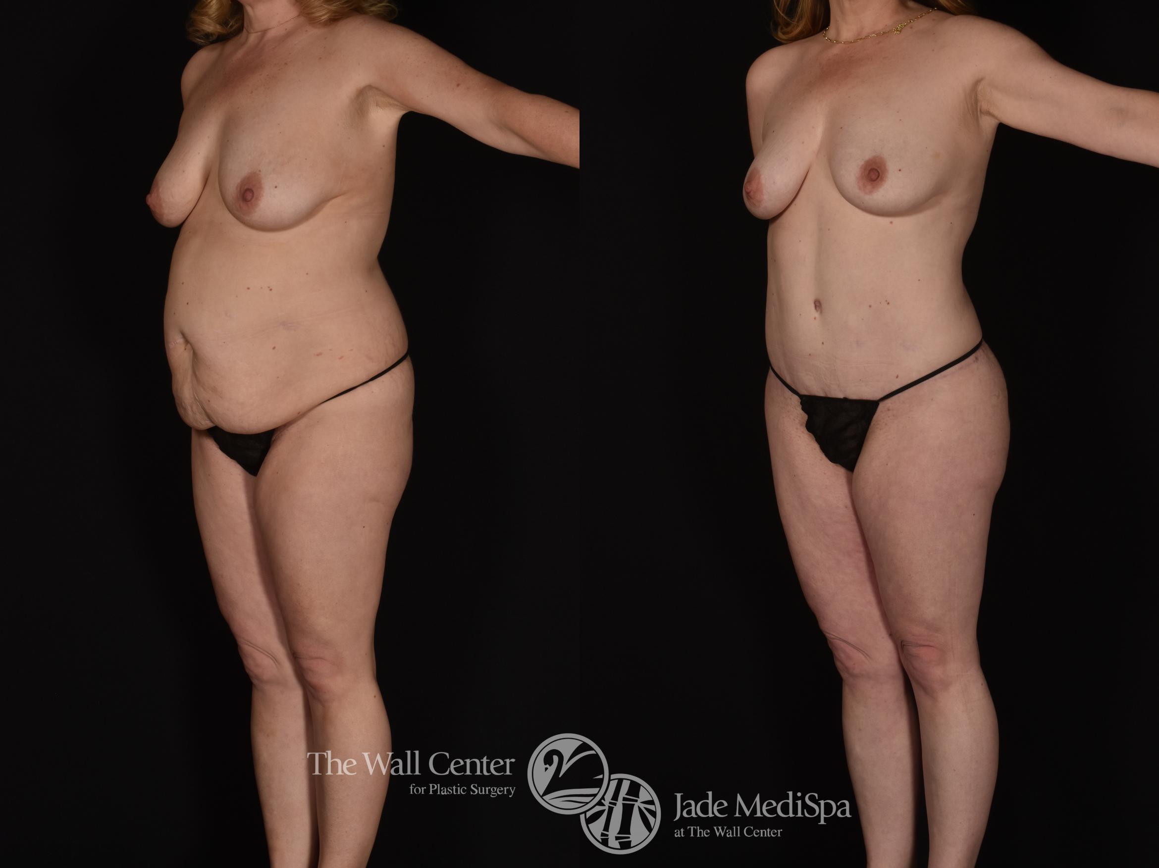 Before & After Tummy Tuck Case 1076 Left Oblique View in Shreveport, LA