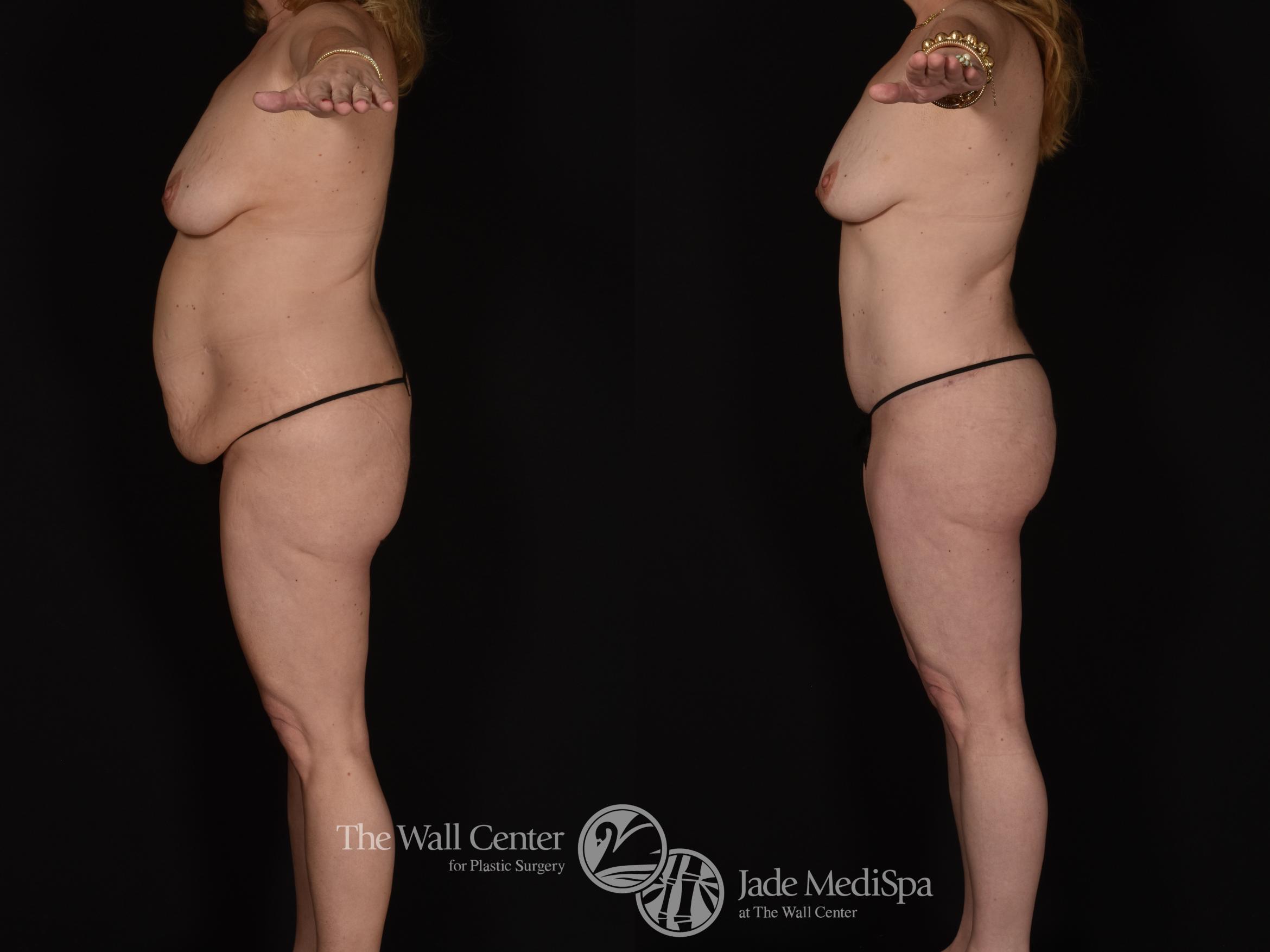Before & After Tummy Tuck Case 1076 Left Side View in Shreveport, LA
