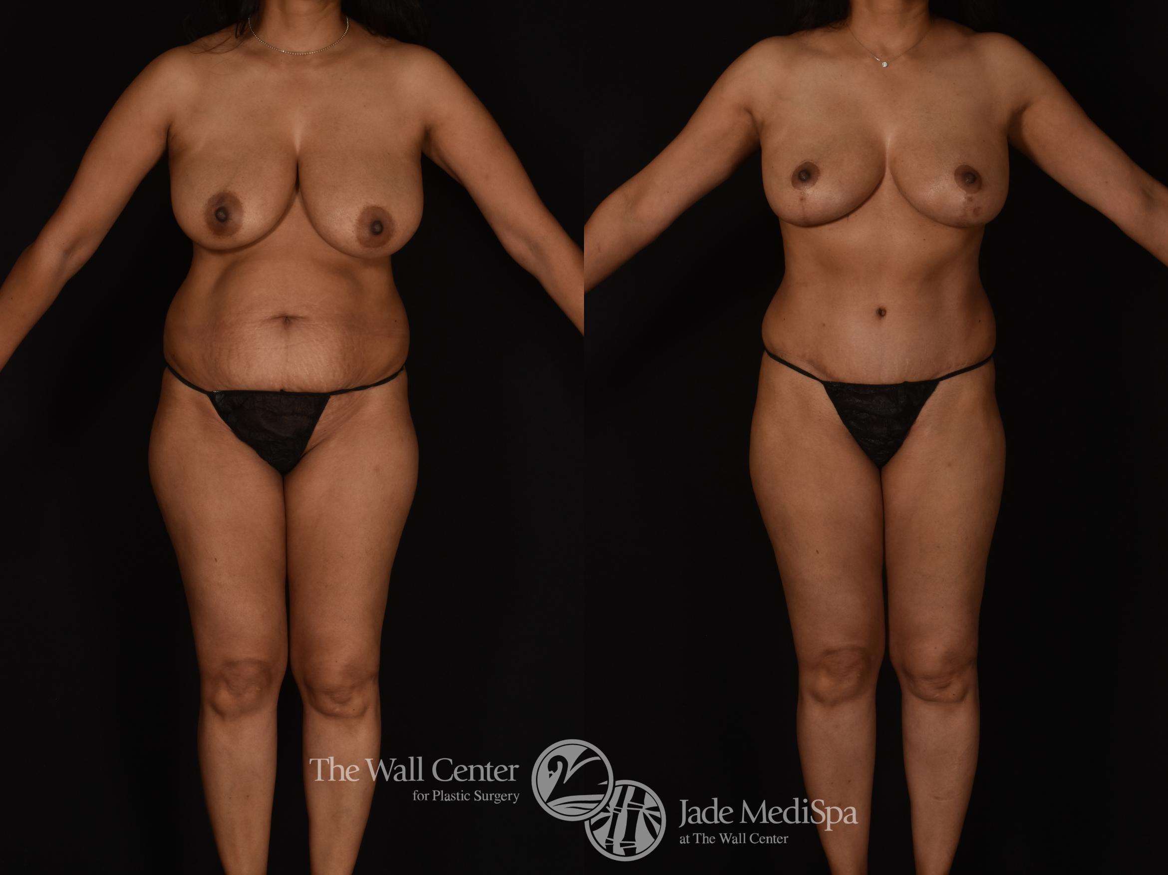 Before & After Tummy Tuck Case 1089 Front View in Shreveport, LA