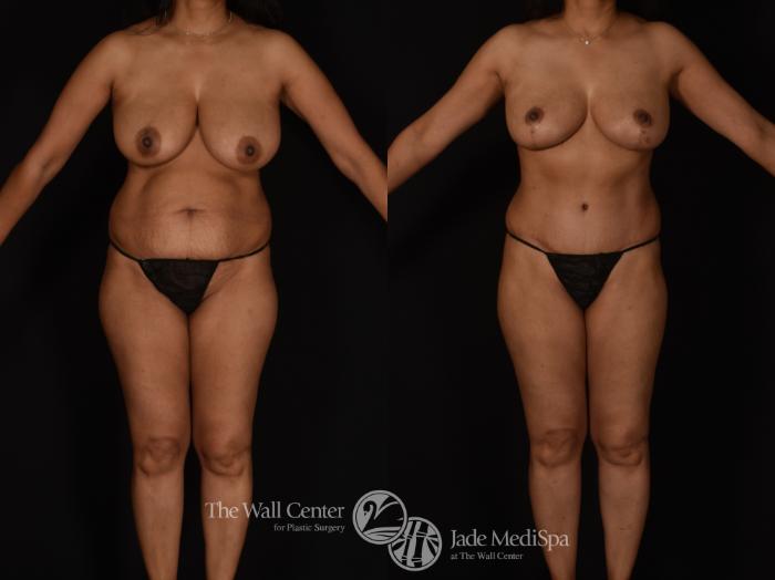 Before & After Tummy Tuck Case 1089 Front View in Shreveport, LA