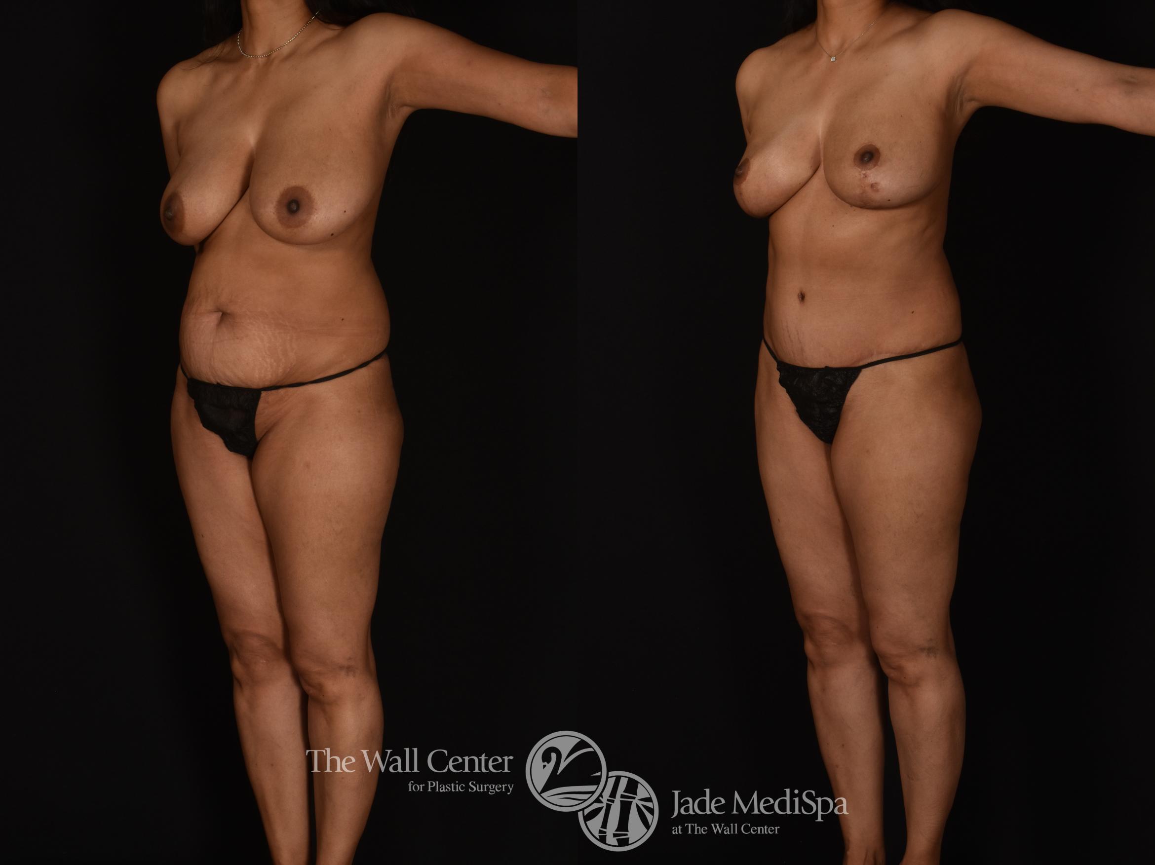Before & After Tummy Tuck Case 1089 Left Oblique View in Shreveport, LA