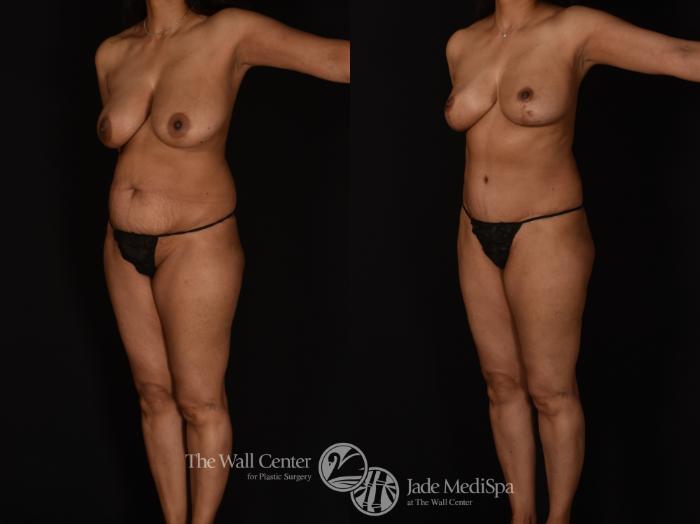 Before & After Tummy Tuck Case 1089 Left Oblique View in Shreveport, LA