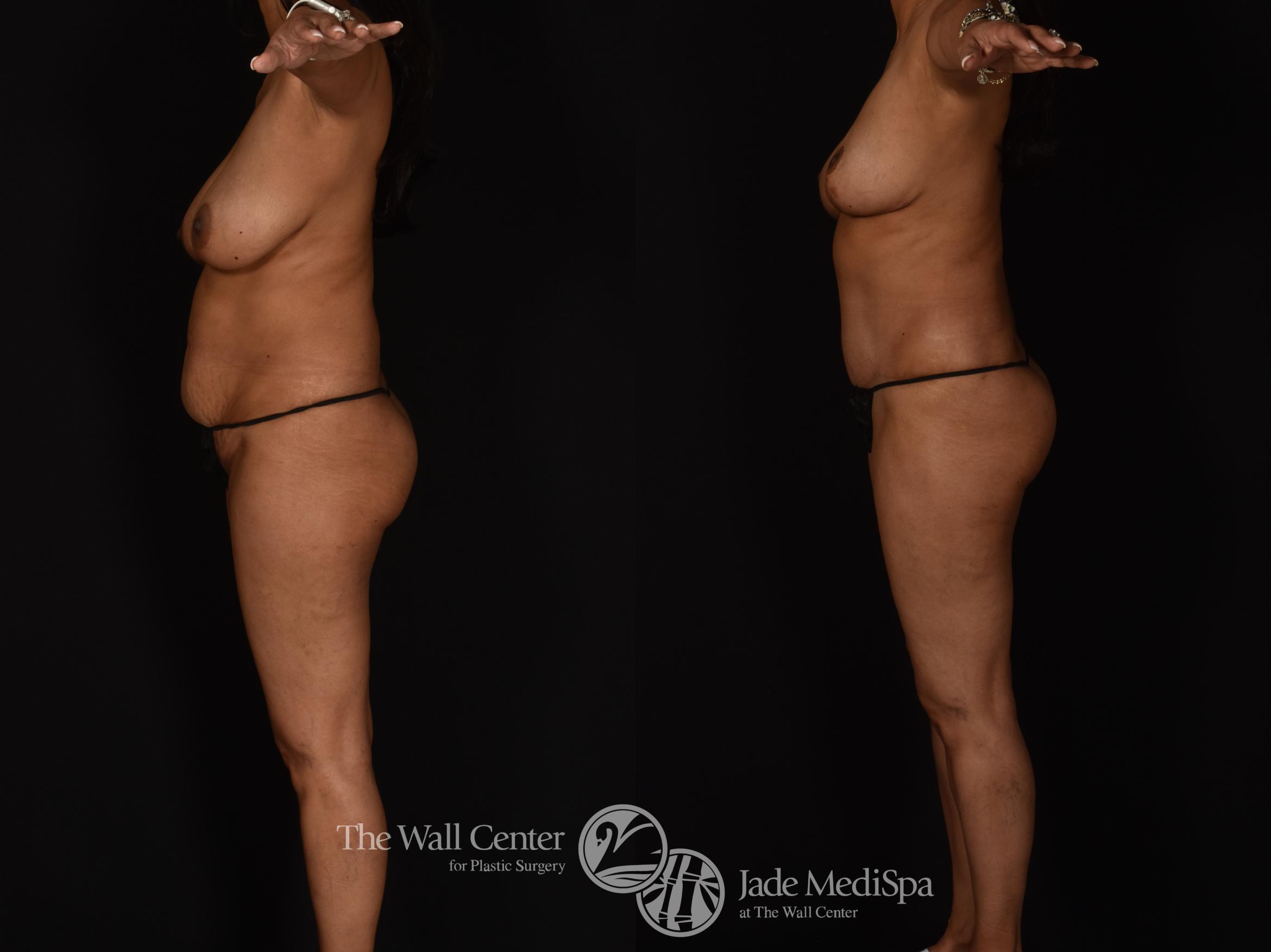 Before & After Tummy Tuck Case 1089 Left Side View in Shreveport, LA
