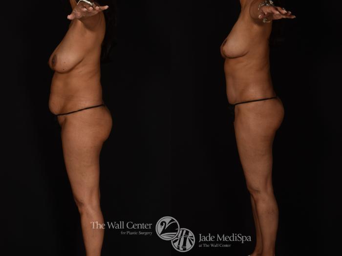 Before & After Tummy Tuck Case 1089 Left Side View in Shreveport, LA