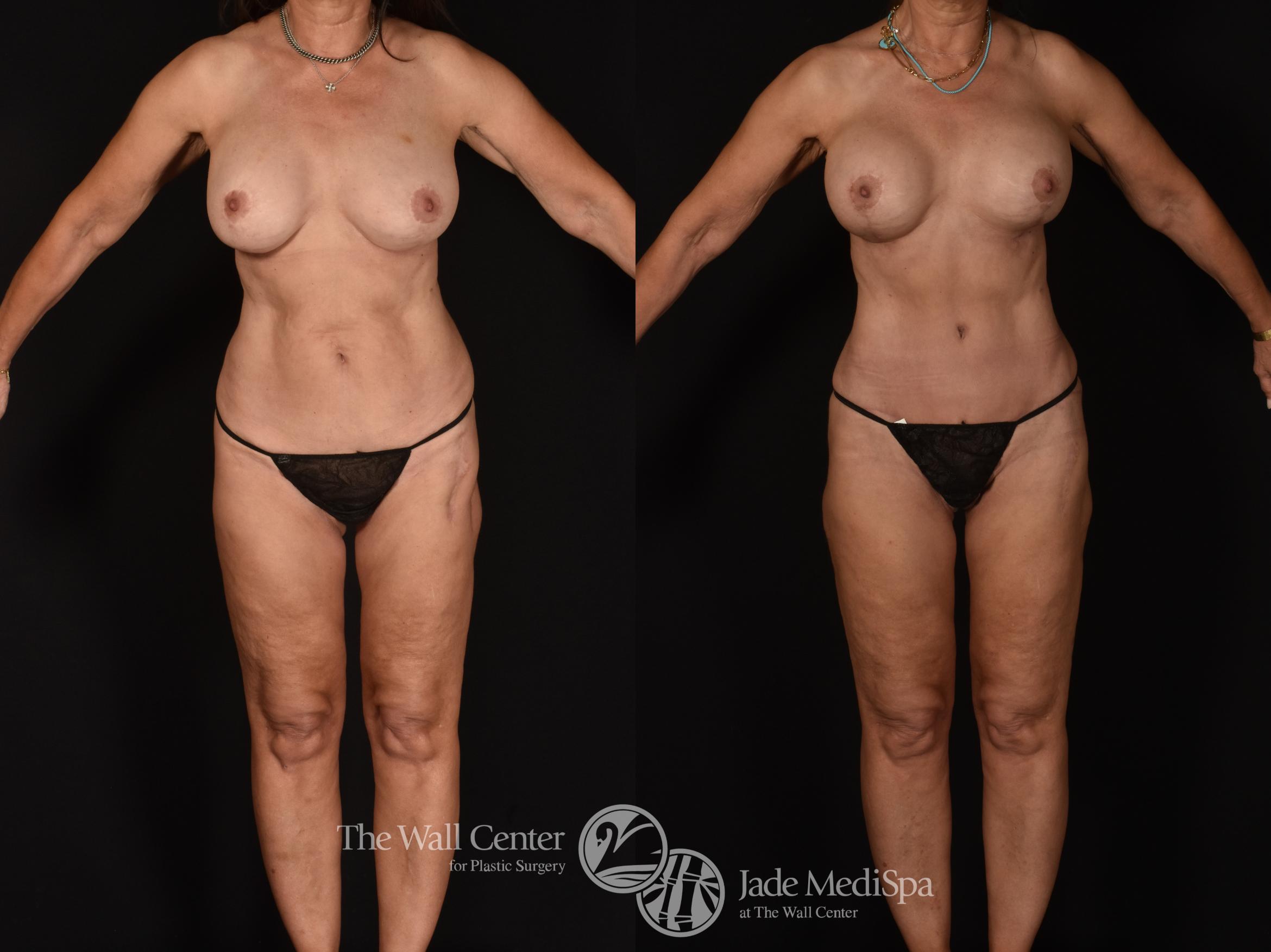 Before & After Tummy Tuck Case 1093 Front View in Shreveport, LA