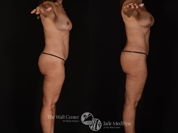 Before & After Tummy Tuck Case 1093 Right Side View in Shreveport, LA