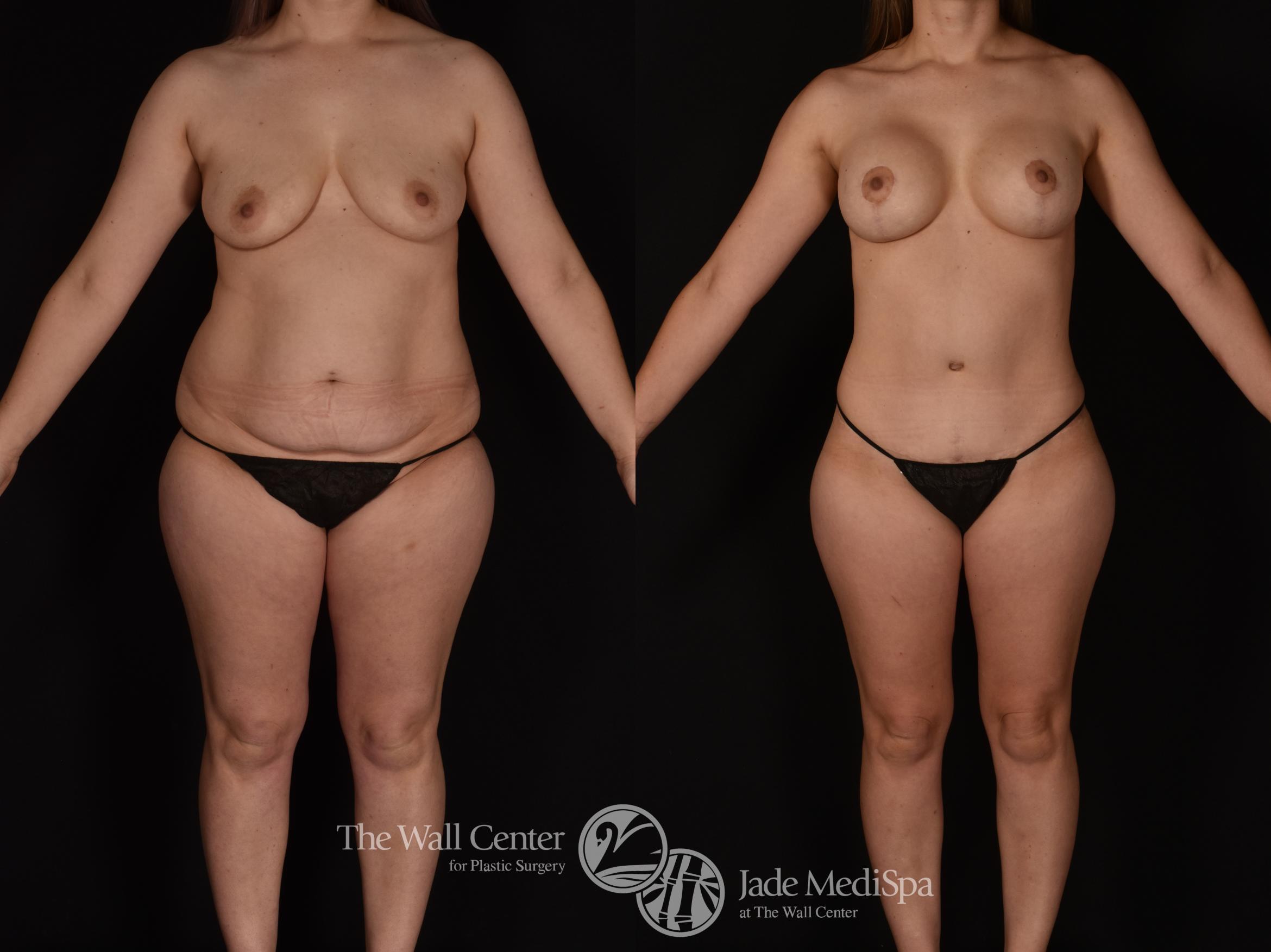 Before & After Tummy Tuck Case 1142 Front View in Shreveport, LA