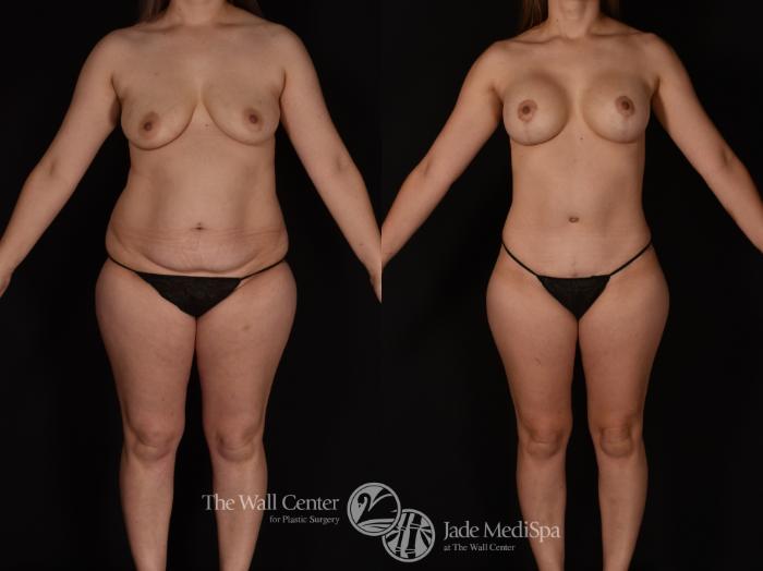 Before & After Tummy Tuck Case 1142 Front View in Shreveport, LA