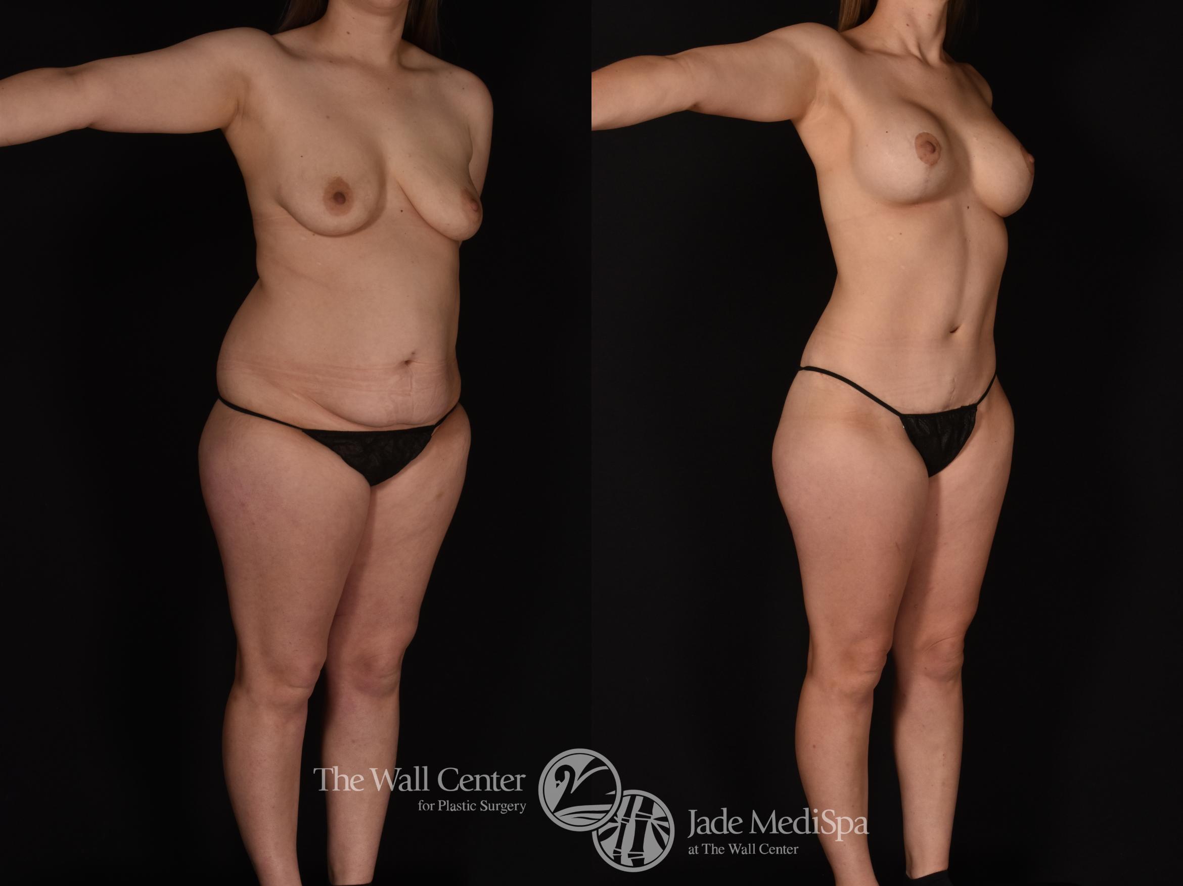 Before & After Tummy Tuck Case 1142 Right Oblique View in Shreveport, LA