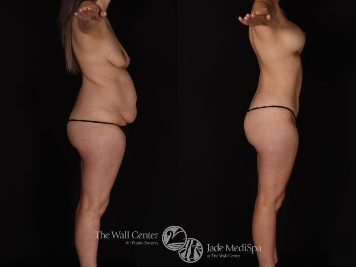 Before & After Tummy Tuck Case 1142 Right Side View in Shreveport, LA