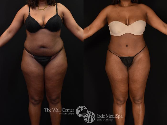 Before & After Tummy Tuck Case 1146 Front View in Shreveport, LA
