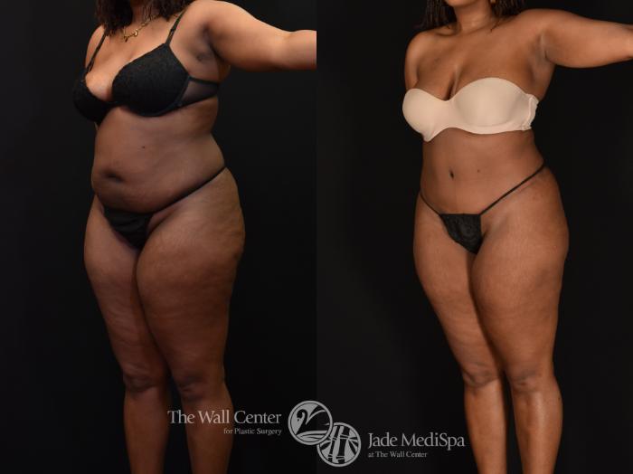Before & After Tummy Tuck Case 1146 Left Oblique View in Shreveport, LA