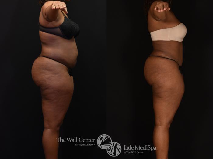 Before & After Tummy Tuck Case 1146 Right Side View in Shreveport, LA