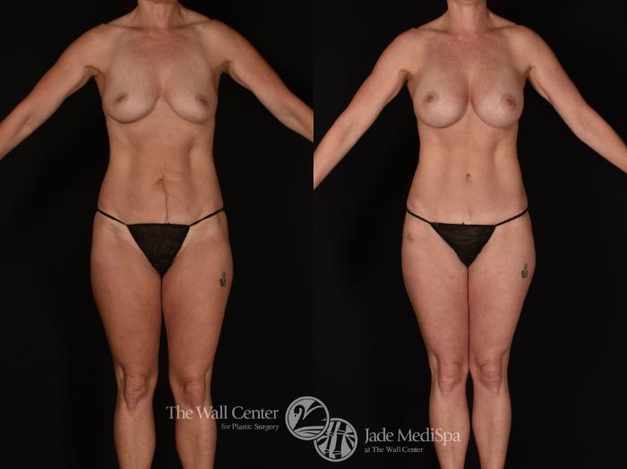 Before & After Tummy Tuck Case 1152 Front View in Shreveport, LA