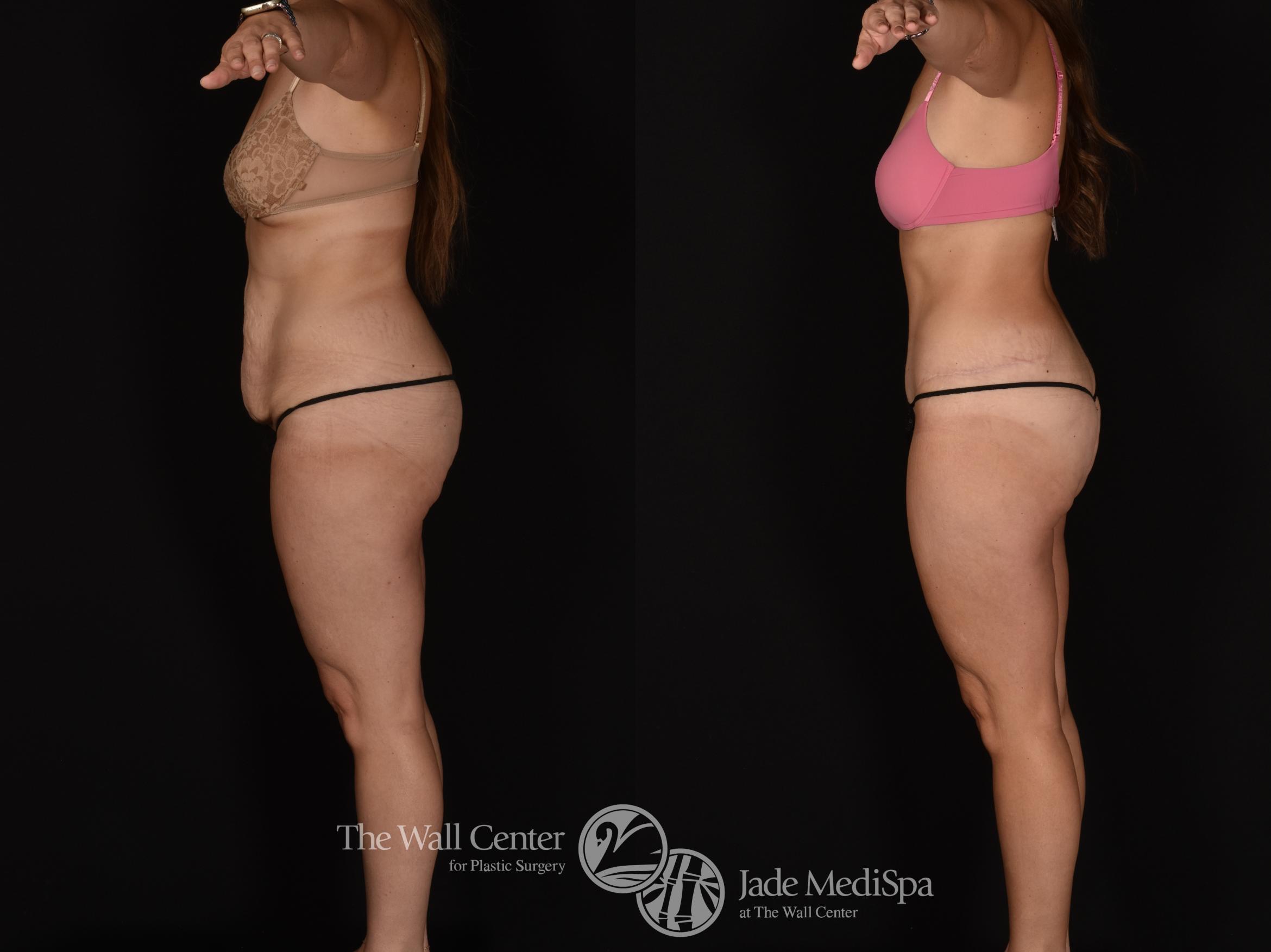 Before & After Tummy Tuck Case 1163 Left Side View in Shreveport, LA