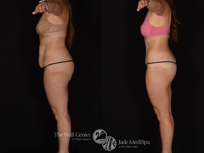 Before & After Tummy Tuck Case 1163 Left Side View in Shreveport, LA